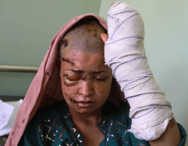 Ciężko ranna Afganka, nieomal spalona przez mężczyzn ze swej rodziny; marzec 2011