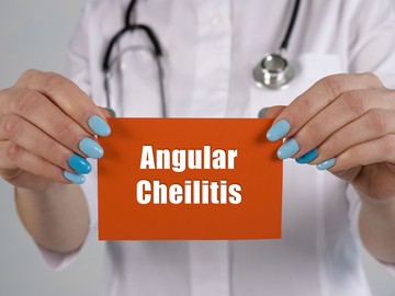 A szájzug gyulladásos berepedezése (cheilitis angularis) egy elég gyakori betegség, melynek kialakulásában szerepet játszhat, gombás fertőzés,vitaminhiányon és rossz szokások is.