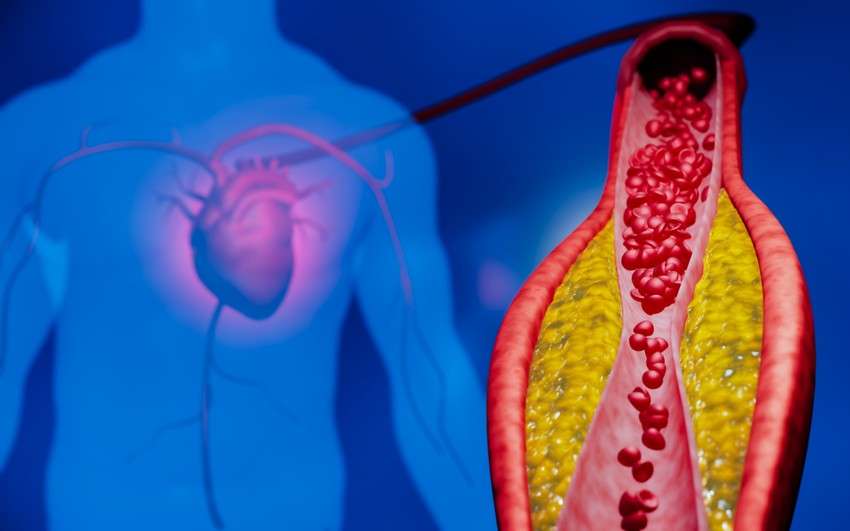 Srčani udar najčešće nastaje kao posledica naglog zapušenja koronarne arterije