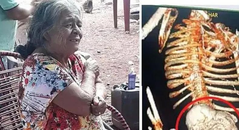 Woman carries dead foetus for 56 years, dies after removal surgery