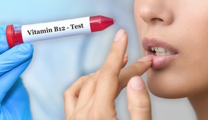 Signali nedostatka vitamina B12 na i u ustima 
