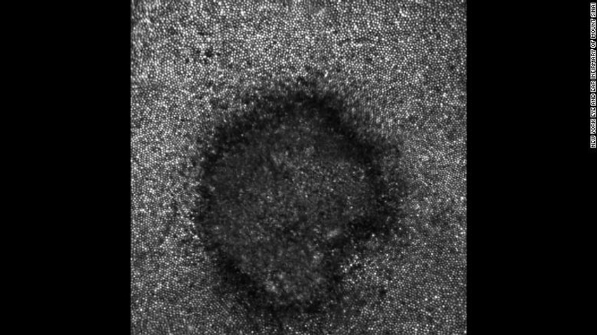 Oštećenje mrežnjače u obliku polumeseca