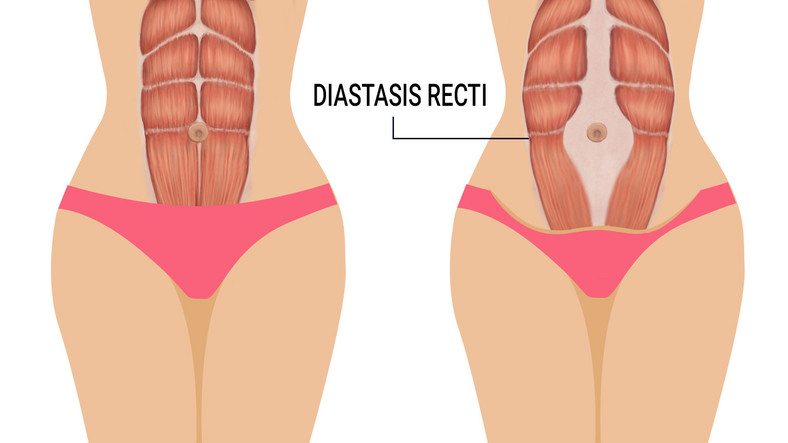 All about postpartum diastasis recti and how to get rid of it [Credit : Vision Exercise Physiology] 