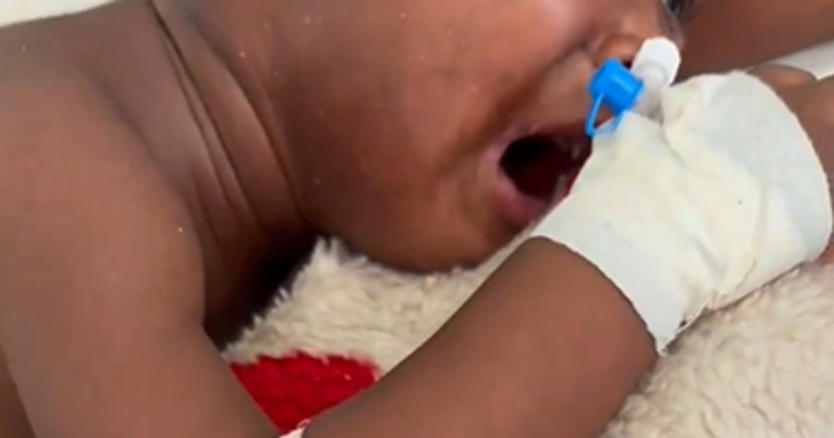 Toddler attacked by dog battles for survival, needs GHC2,700 weekly for treatment - Vimarsana News