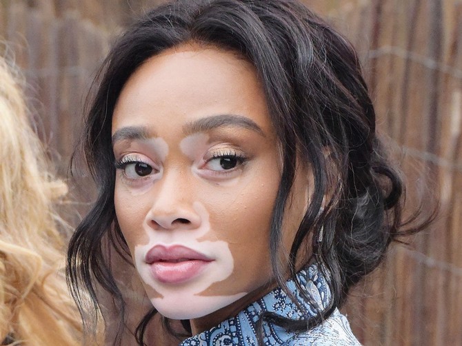 Zahvaljujući manekenki Vini Harlou ceo svet zna šta je vitiligo