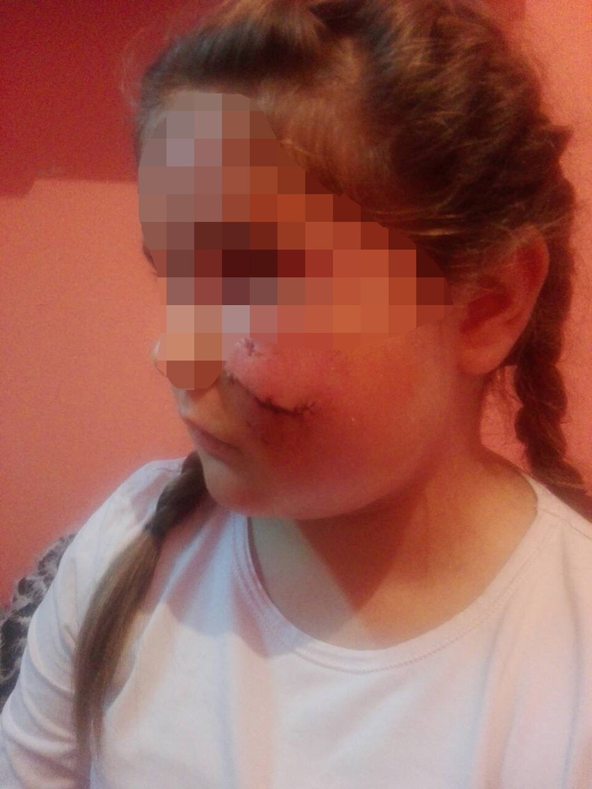 Ožiljci Dunje Dedić (10) pre prvih komplikacija