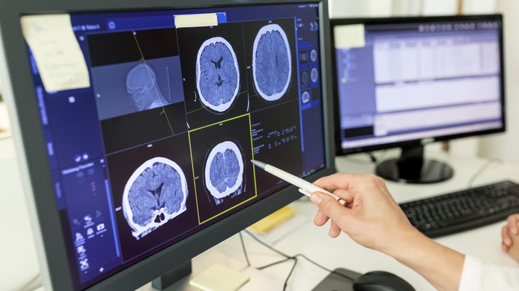agydaganat, agyrák, diagnosztizálás, biopszia, vérkép