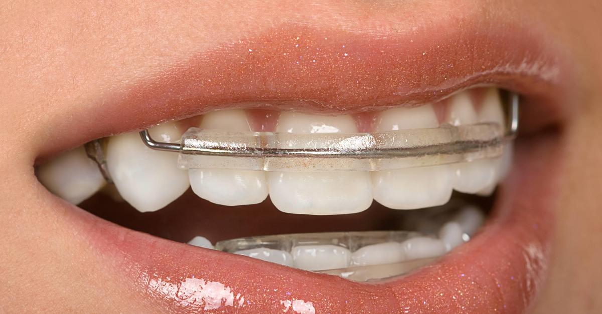 Aparaty ortodontyczne samoligaturujące. Dla kogo, jak dobrać i ile kosztują?