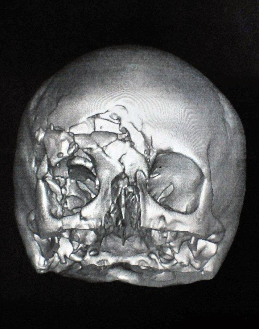 Na obrazie z rtg czaszka Danuty wygląda jak popękana skorupka jajka