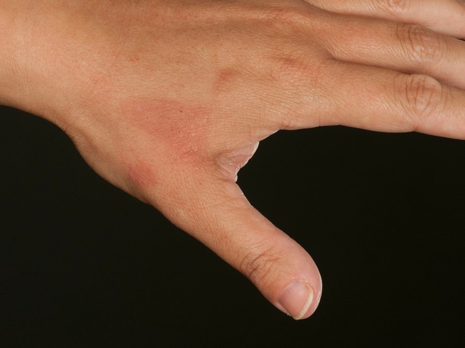 Saznajte sve što vas zanima o psorijazi od stručnih lica