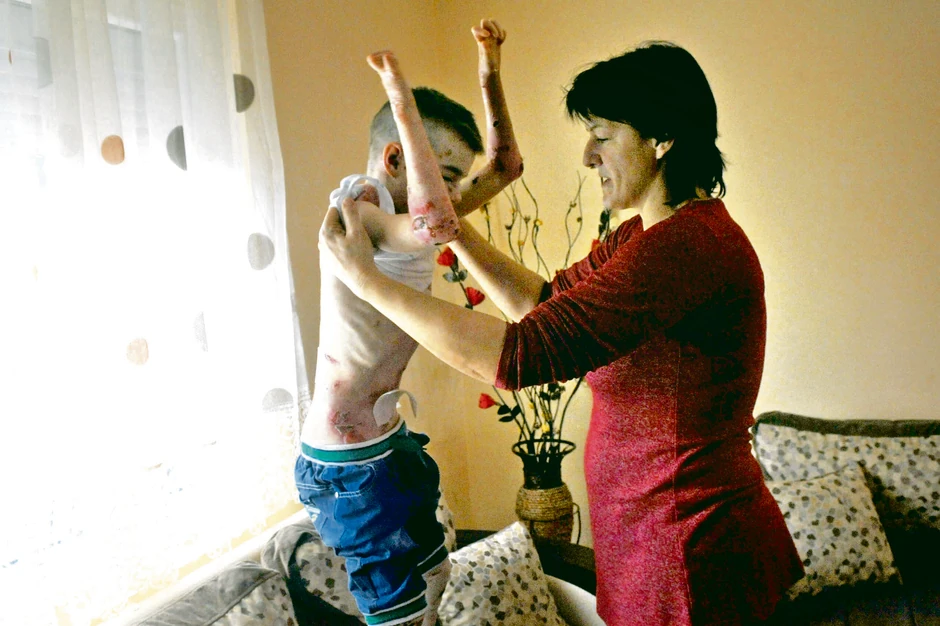 Mučna svakodnevica: I najblaži dodir dečaku nanosi bol