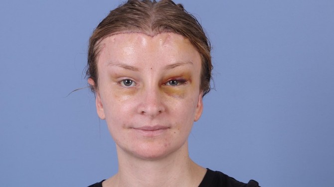 Fotografija nastala nekoliko dana posle operacije