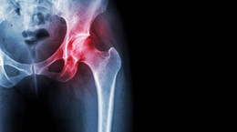 Reemplazo de rodilla y cadera - indicaciones, rehabilitación