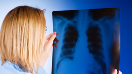 Rak płuca staje się chorobą przewlekłą