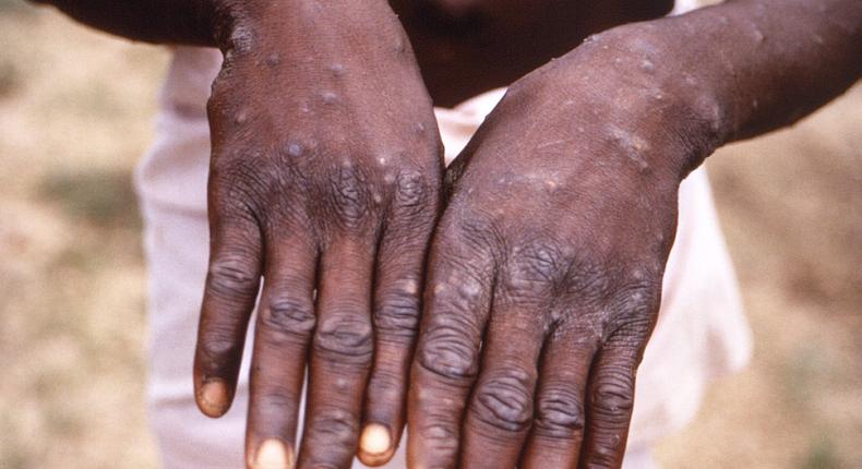 Monkeypox: Nigeria records additional 41 cases 7 days.