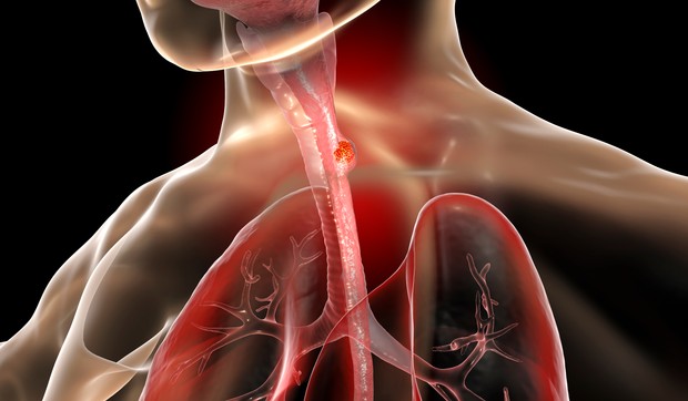 Pacijenti bez vidljivog Barrett-ovog jednjaka imali su uznapredovali rak u istraživanju 