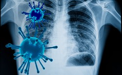 Prof. Bassetti: Wcześniej koronawirus mknął niczym autostradą do płuc, teraz napotyka przeszkody