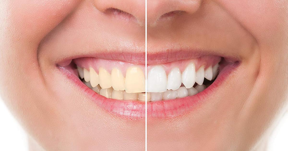 teeth whitening natural