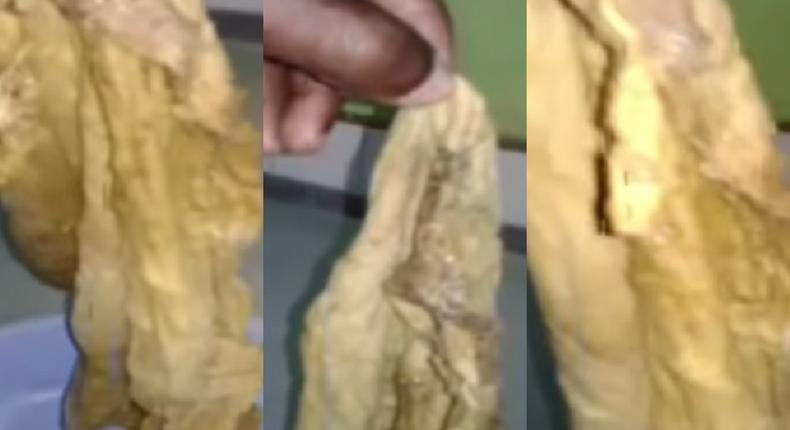 Ridge Hospital again? Doctors leave huge towel in woman’s tummy for 9 months after caesarian section (video)