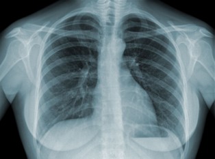 Krztusiec, gruźlica, błonica. Prof. Czauderna: W Polsce mogą się pojawić choroby, które od dawna nie występowały