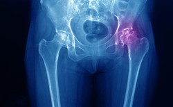 Przed nami dwukrotny wzrost liczby groźnych dla życia złamań. Jak to zatrzymać?