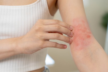 Mi csíphetett meg? Így következtetheti ki a csípésnyomok alapján