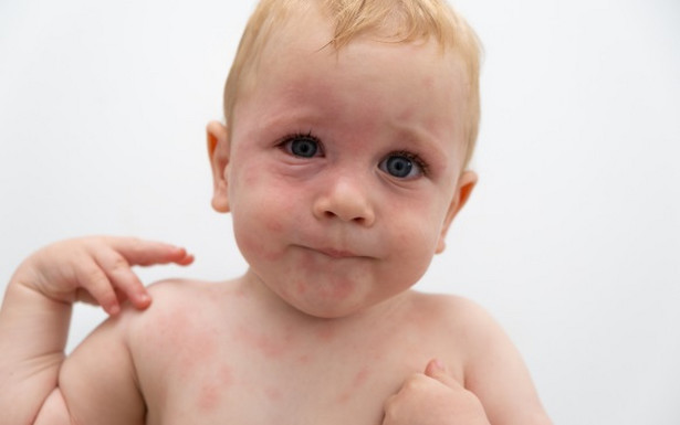Plamy na twarzy i klatce piersiowej to jedna z możliwych skórnych reakcji organizmu dotkniętego anafilaksją
