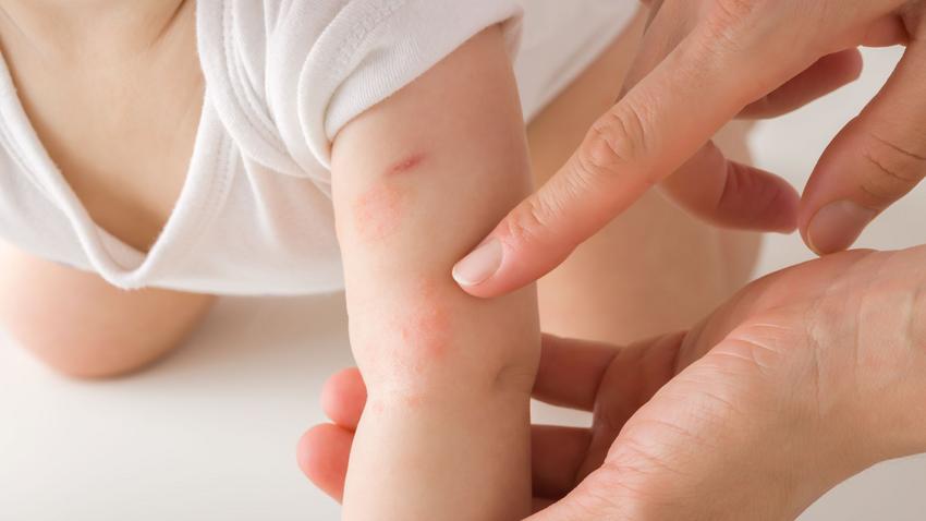Mi okozhat kiütéseket a csecsemő bőrén pirosság