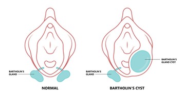 Bartholin-mirigy kialakulhat a mirigy elzáródása (ciszta) után, amikor a pangó váladék bakteriális fertőzés révén felülfertőződik és gennyesedik. Jellegzetes tünetei az erős, fájdalmas duzzanat, amely székletürítést, járást, ülést is lehetetlenné tehet, valamint láz és vörösödés is előfordulhat. Kezelése műtéttel történik, ahol a tályogot megnyitják, a gennyes tartalmat leengedik és fertőtlenítik, a beteget pedig antibiotikummal is kezelik.