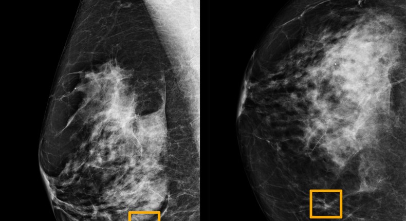 DeepMind mammogram