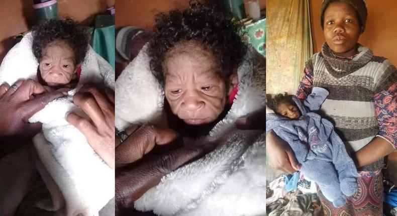 Rare condition makes 2-month-old baby girl look old with wrinkled face