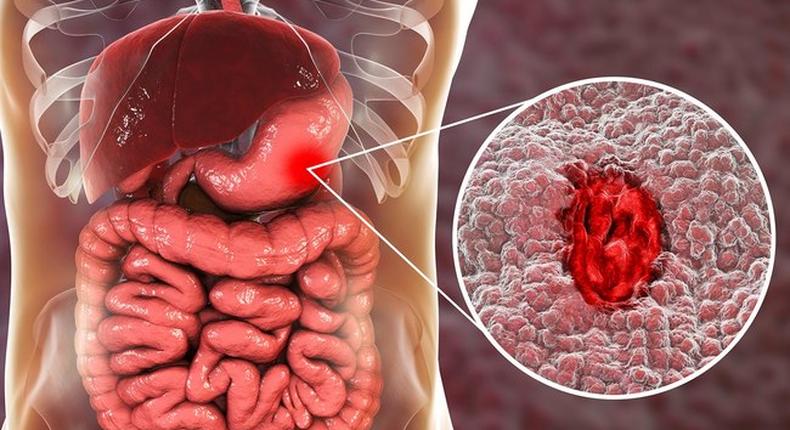 Get to know the 9 glaring stomach ulcer symptoms you can’t ignore [Credit: Web MD]