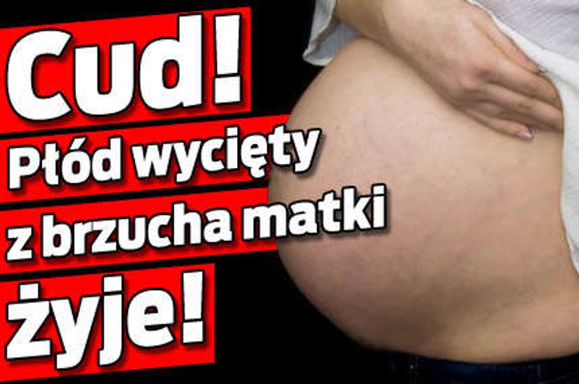 Płód wycięty z brzucha matki żyje!