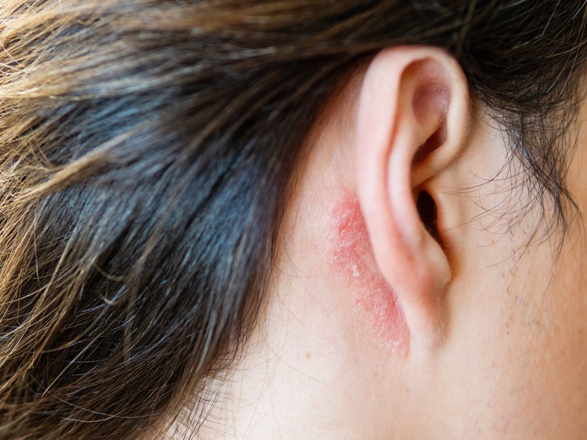 Koristite minđuše od hirurškog čelika ili od najfinijeg zlata