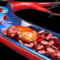 Így előzheti meg a szívelégtelenséget és a stroke-ot