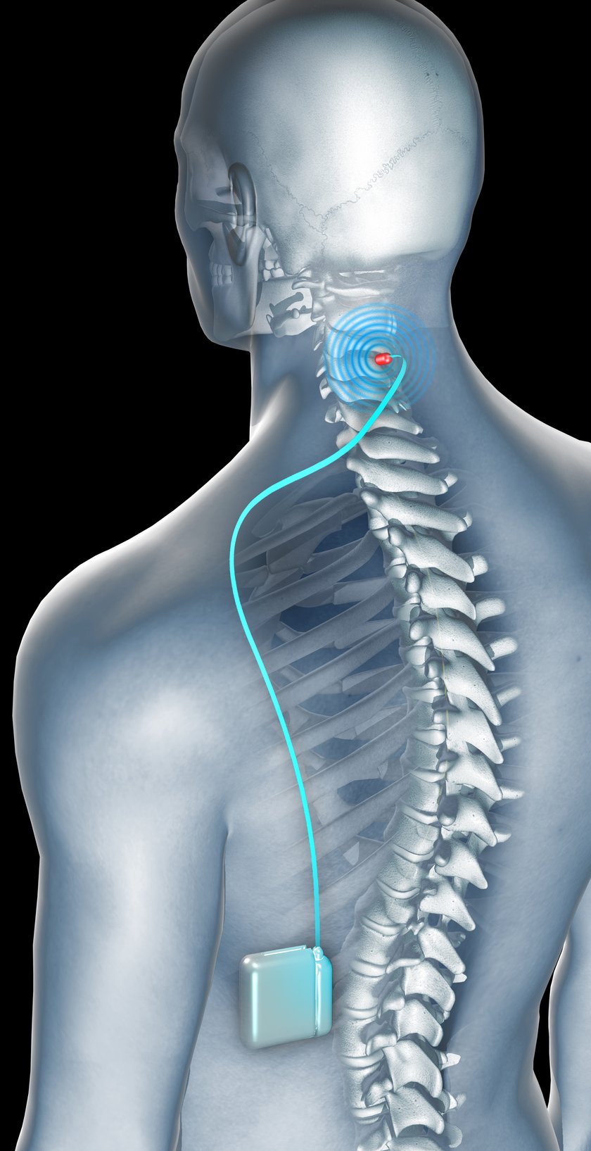 wszczepianie stymulatorów rdzenia kręgowego