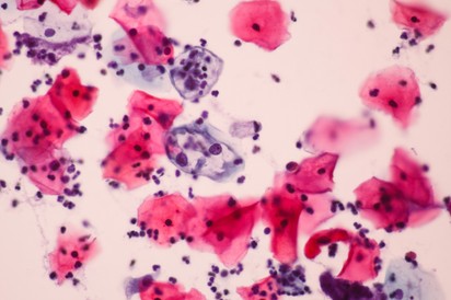 HPV vírus: hogyan lehet elkapni?