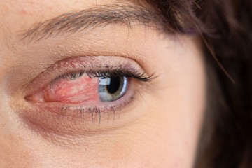 szem rosacea, pirosság, vérerek