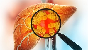 Metabolička bolest jetre je često povezana sa viškom kilograma 