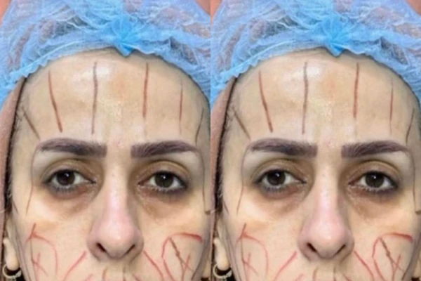 "Ne liči na sebe, MORAĆE da vadi nova dokumenta": Plastični hirurg pokazao slike PRE i POSLE plastičnih OPERACIJA i rezultati su da NE POVERUJETE