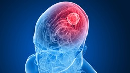 nowy trop w leczeniu glejaka wielopostaciowego: rola metabolizmu frukt