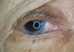 Starenje je najveći faktor rizika za razvoj entropiona.