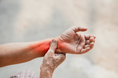 Rheumatoid artritisz: ez is okozhatja a reggeli ízületi merevséget