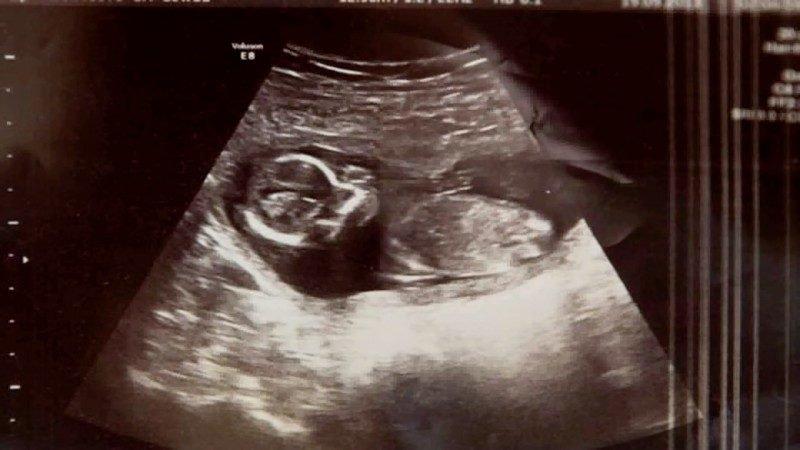 Az orvosok nem hittek a fülüknek, amikor10 nappal az abortusz után meghallották a kisbaba szívverését a nő hasában