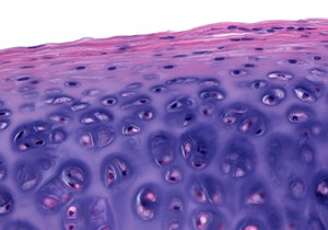 Nekoliko stvari može da izazove visok broj bazofila