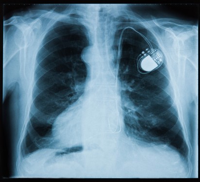 Pacemaker, defibrillátor beültetése: ezekben az esetekben szükséges