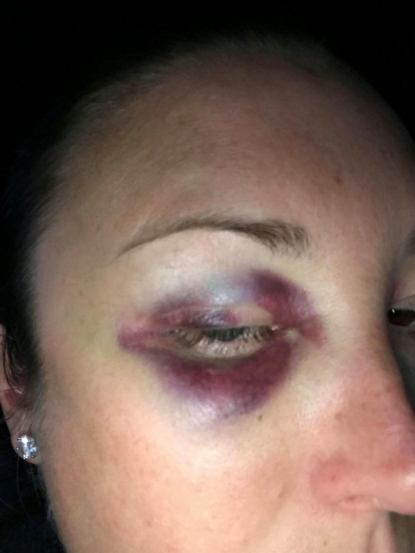 Ofiara bicia pokazała zdjęcia obrażeń. Zrobił jej to mąż bisznesmen