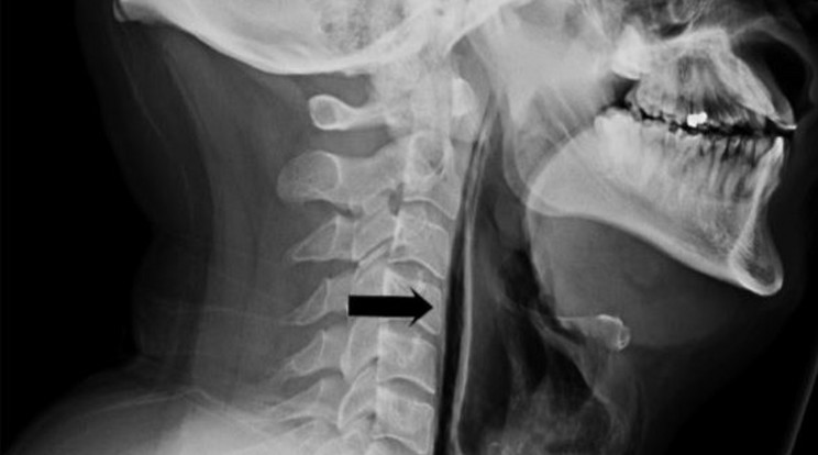 Akkorát tüsszentett, hogy elrepedt a légcsöve /Fotó: BMJ -Wanding Yang