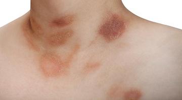 milyen betegségek alatt vörös foltok jelennek meg a bőrön