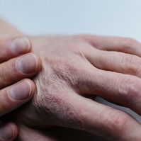 Telente száraz, cserepes a keze? Ezt tanácsolja a bőrgyógyász